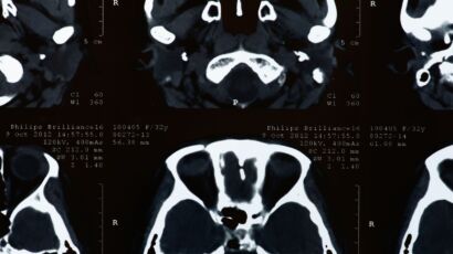 Cerebral palsy claims